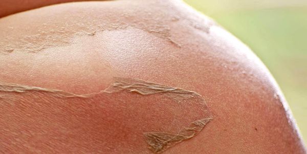 Что за болезнь называют «Синдром ошпаренной кожи»? Рассказывает врач-комбустиолог